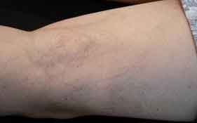 VÁRICES TELANGIECTASIAS