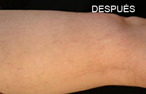 TELANGIECTASIA-DESPUES