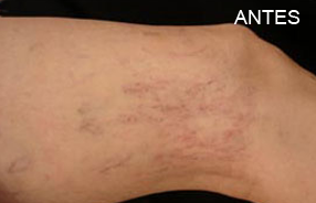 TELANGIECTASIAS-ANTES
