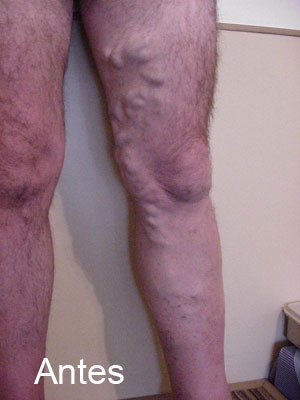 Varices-y-telangestacias-antes-1