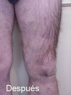 Varices-y-telangestacias-despues2